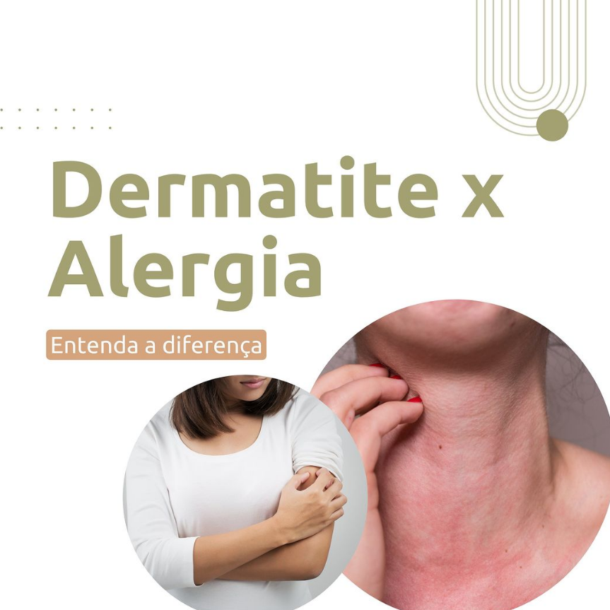 Dermatite x Alergia - Entenda a diferença