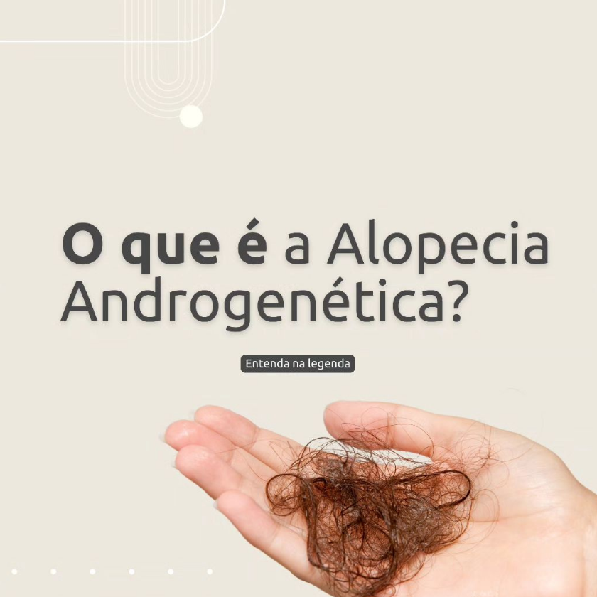 O que é Alopecia Androgenética?